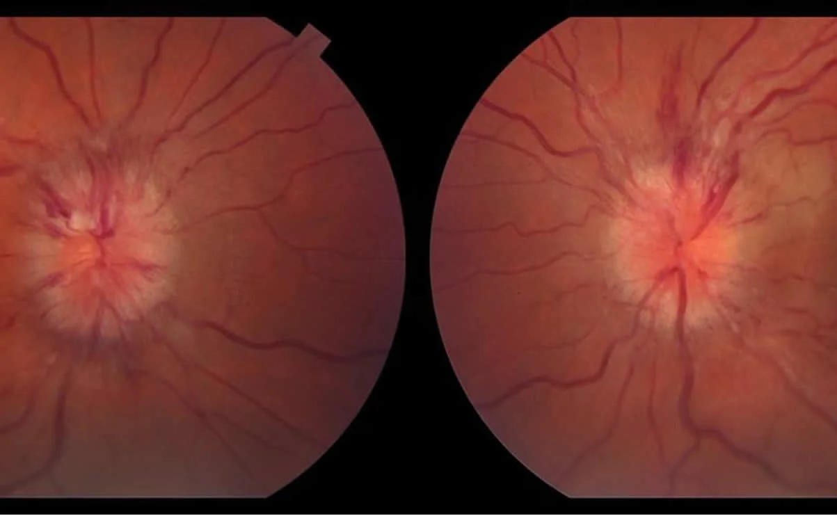 Papiledema secundario a hipertensión intracraneal